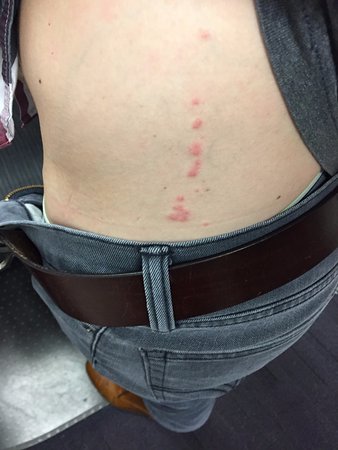 床蝨咬痕圖片 21