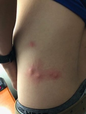 床蝨咬痕圖片 22